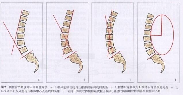 因此,vrtovec等提出利用脊柱各個腰段椎體的前緣或後緣切線構成的角度