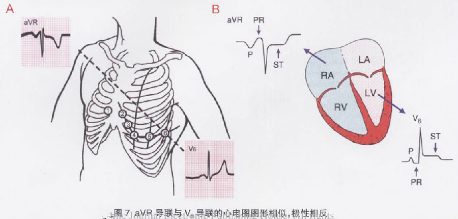 标准,专用于左室室速的诊断①qrs波时限>140ms②电轴左偏③v1导联