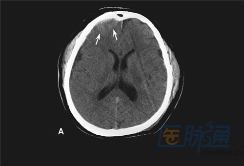 两侧头皮血肿也很明显(红色箭头.右边的图片是同一个病人第二天做的.