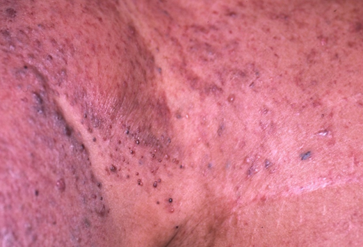 乳腺癌红斑图片 皮肤图片