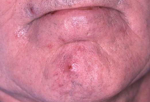 有brca2(乳腺癌2型敏感性蛋白)阳性家族病史.