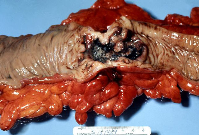 结肠良性肿瘤图片图片