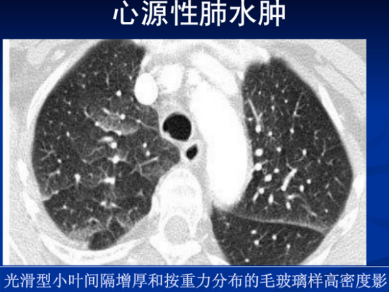 不同类型肺水肿的ct表现(上)