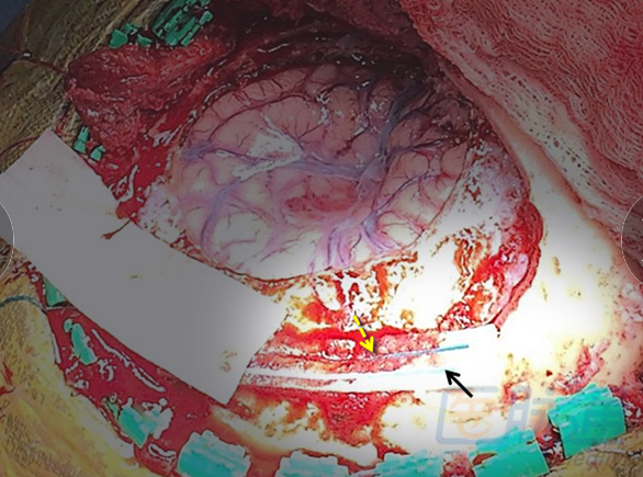 额叶手术切口_额叶切除手术废除_额叶切除手术