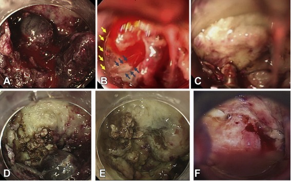 内镜下止血钳治疗活动性宫颈出血