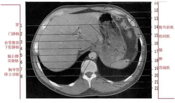 胸腺ct图片位置图解图片