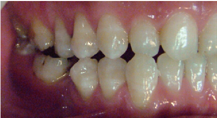 王美青:凸凹式后牙咬合接触及其临床意义