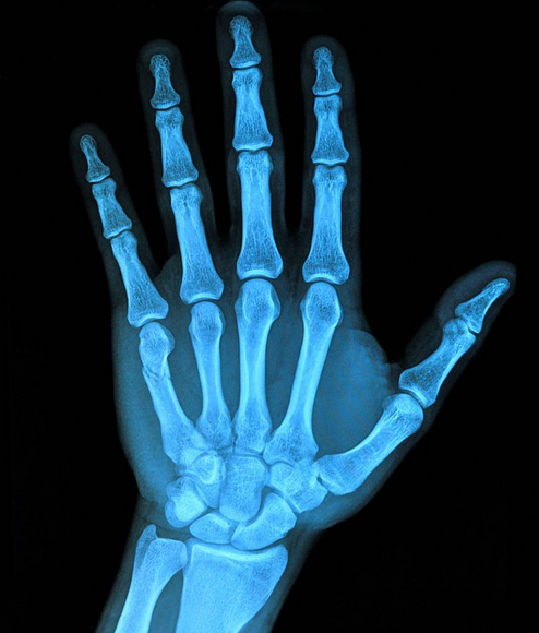 手部肌腱炎症可预测骨关节炎