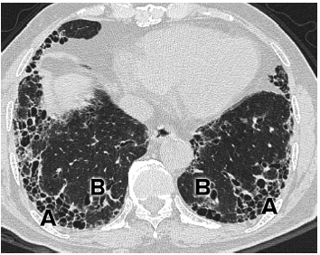 呼吸内科专业讨论版 69 间质性肺疾病的诊断与治疗(下) 过敏性肺炎
