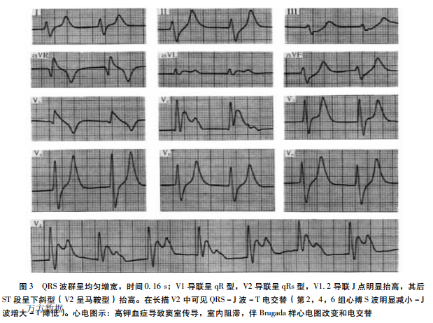 高钾血症 临床关注的心电图问题