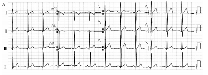右室肥厚心电图诊断新视点