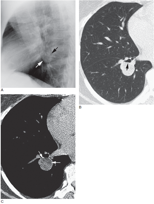 肺错构瘤影像图片