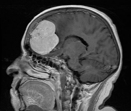 图文详解脑膜瘤特点与治疗