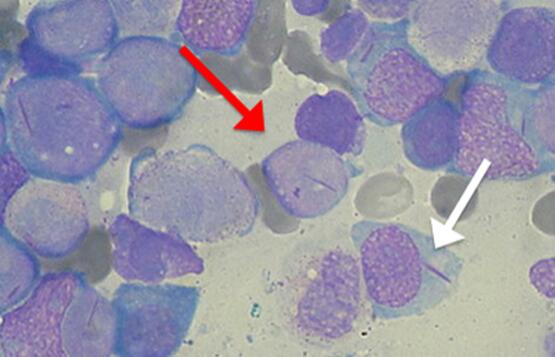 图3外周血涂片显示存在auer小体(白色箭头)和原始细胞(红色箭头),确定