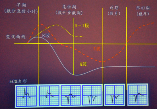 損傷和壞死型特徵的圖形)二,急性心肌梗死心電圖圖2-3 正常心電圖波