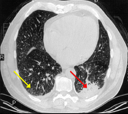 图文并茂丨一例罕见肺感染下