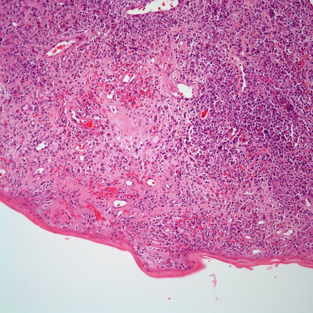 图说 ▍非霍奇金淋巴瘤(下篇)