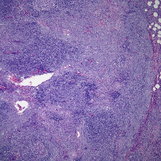 图23  黏膜相关淋巴组织(malt)淋巴瘤单核细胞增殖