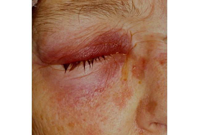 答案及解析│5个细菌性皮肤感染小问答