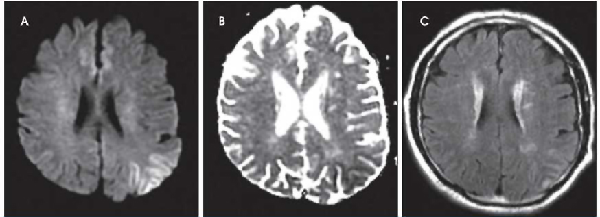 脑卒中影像学鉴别诊断(一):灰质白质改变