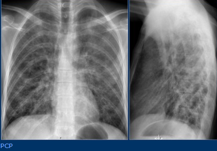 间质性肺炎x线图片图片