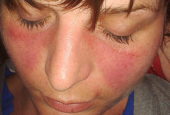 图文并茂:风湿性疾病的皮肤症状之sle,亚急性皮肤型红斑狼疮,慢性盘状