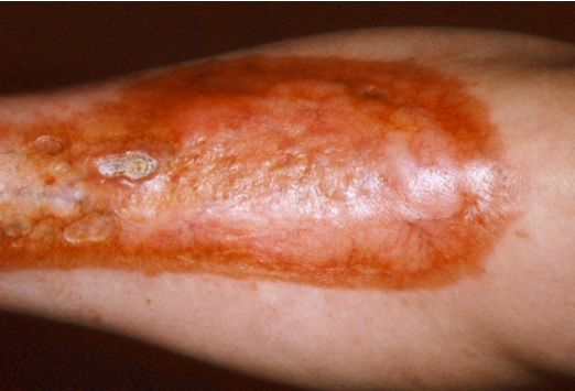 答案:类脂质渐进性坏死