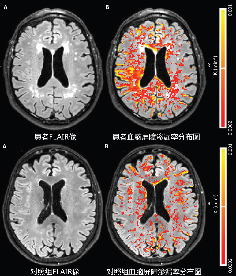 血脑屏障受损图片