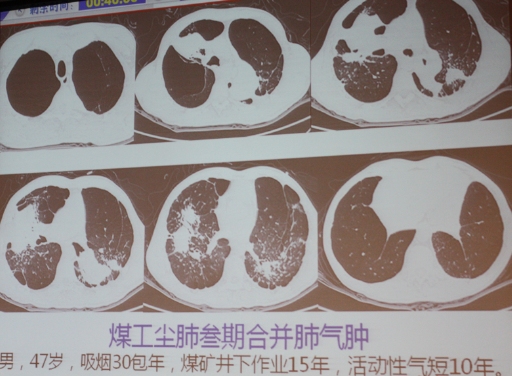 叶俏教授:尘肺病的综合诊治策略