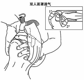 双人良好的面罩通气绝大多数情况能够坚持到麻醉科同事的到来.