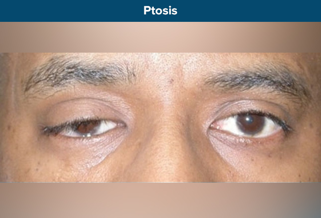 丘脑病变可产生各种眼球运动障碍,包括垂直凝视麻痹,瞳孔和眼睑畸形