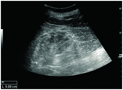 腎小球腎炎引起的慢性腎臟病:皮質變薄,回聲增強. ,虛線:腎臟長度