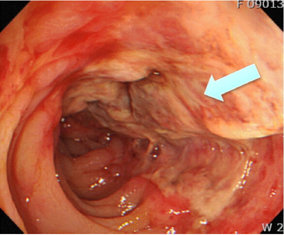 图2缺血性结肠炎肠段炎症性黏膜和单条纹征(溃疡性或炎症性结肠单条