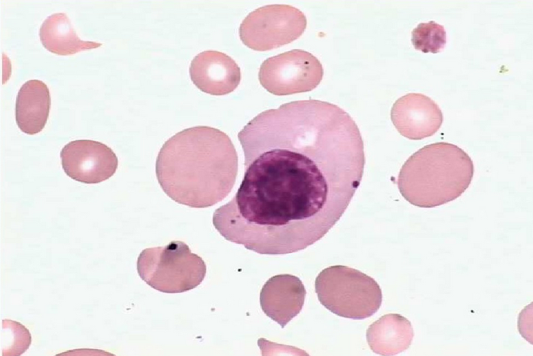 巨晚幼红细胞