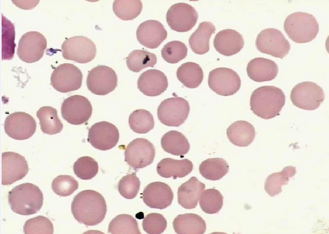 几种红细胞形态异常     球形红细胞,直径通常小于6μm,厚度增加统＃