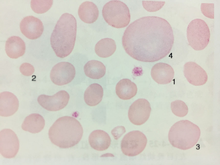 小紅細胞;3.大紅細胞;4.巨紅細胞
