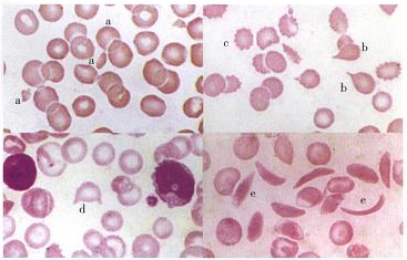 于肝病,脾切除,无p脂蛋白血症;     泪滴状红细胞常见于骨髓纤维化