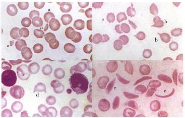 新月形红细胞图片图片