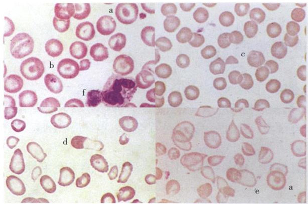 于肝病,脾切除,无p脂蛋白血症;     泪滴状红细胞常见于骨髓纤维化
