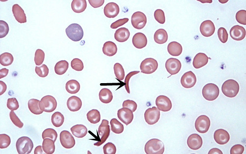 镰形红细胞提示HbF增高图片