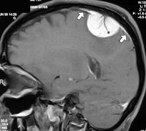 一例脑膜瘤患者,可见t1增强脑膜尾征