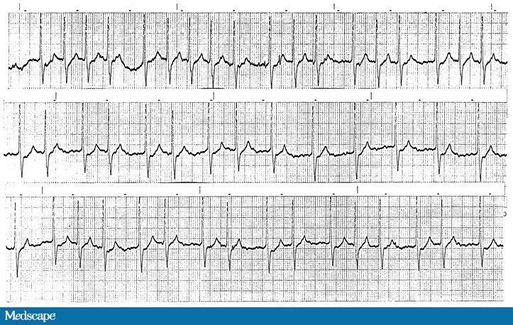 答案:心室传导可变的交界性心动过速,心房颤动,高度提示洋地黄中毒.