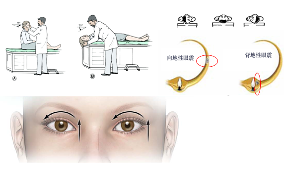 眼震图前庭功能检查图片