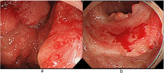 乙状结肠癌 早期症状图片