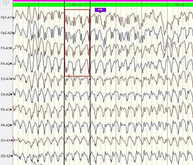 失神发作脑电图特点图片
