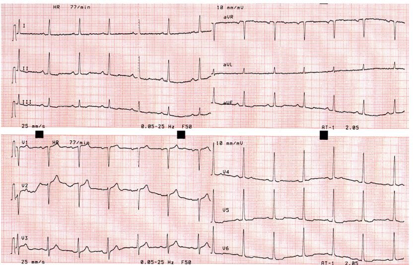 wellens综合征具有典型的心电图表现,胸痛缓解期胸前导联表现为t波