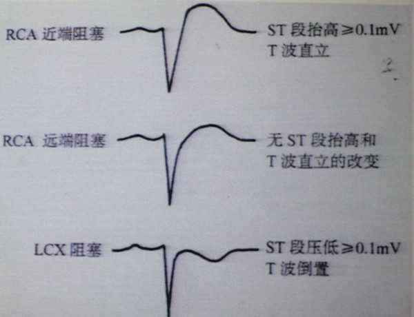 [chrs2017]张海澄:牢记这6种心电图表现,还怕发现不了右室梗死吗