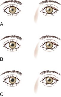 瞳孔不等大:动眼神经麻痹还是horner综合征?