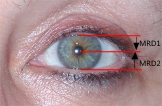 瞳孔不等大:动眼神经麻痹还是horner综合征?
