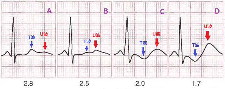 「老刘学图」如何从心电图中识别低钾血症?
